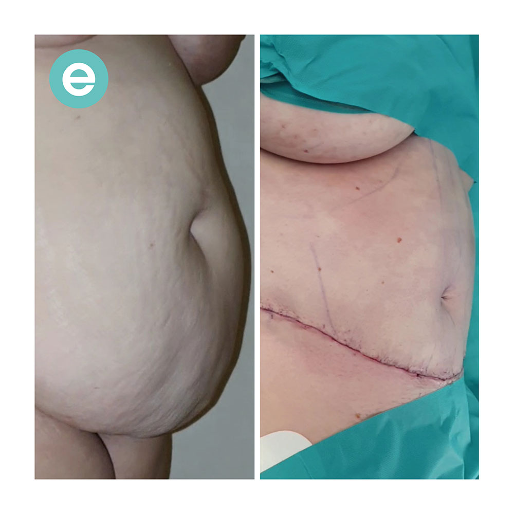 Abdominoplastia con técnica de Tulua: una técnica de cirugía estética para  corregir el abdomen y crear un nuevo ombligo