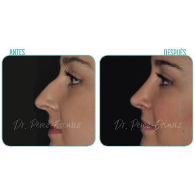 Rinoplastia Cerrada