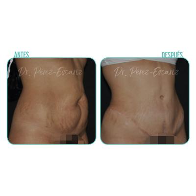 Escariz 191226 Casoreal Abdominoplastia 2