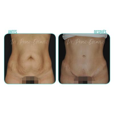 Escariz 191226 Casoreal Abdominoplastia 5