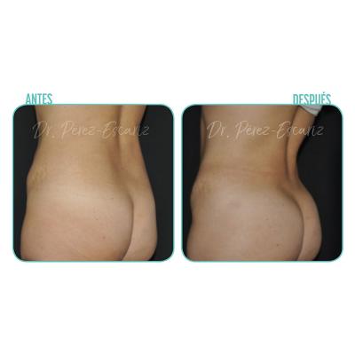 Escariz 191226 Casoreal Abdominoplastia 7