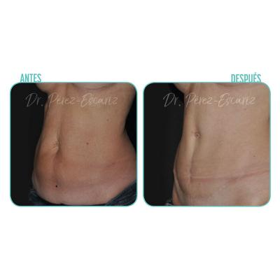 Escariz 190205 Casoreal Abdominoplastia 3