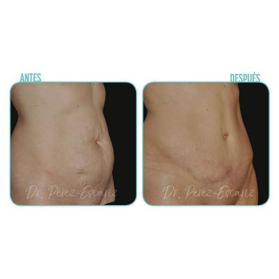 Escariz 190326 Casoreal Abdominoplastia 4