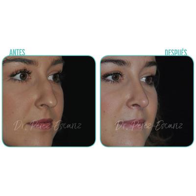 Rinoplastia 2751 Escariz 3