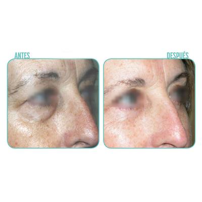 Escariz Blefaroplastia1 Casoreal 2