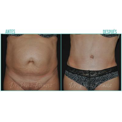 Escariz 211102 Casoreal Abdominoplastia Web2022 1