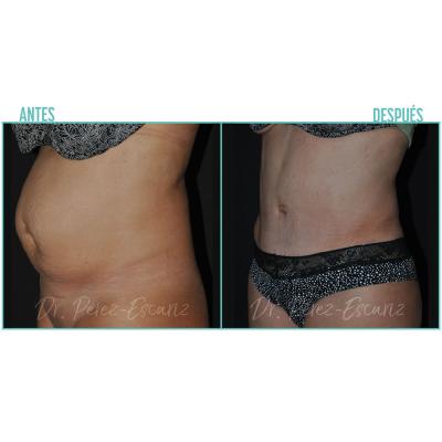 Escariz 211102 Casoreal Abdominoplastia Web2022 2