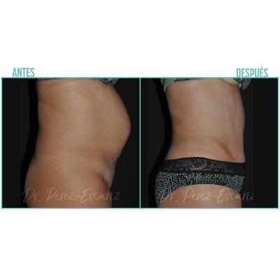 Escariz 211102 Casoreal Abdominoplastia Web2022 3