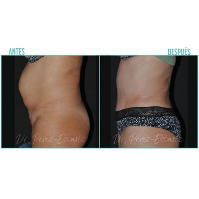 Escariz 211102 Casoreal Abdominoplastia Web2022 4