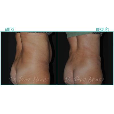 Escariz 211102 Casoreal Abdominoplastia Web2022 5