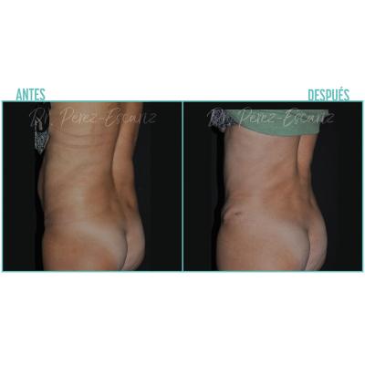 Escariz 211102 Casoreal Abdominoplastia Web2022 6