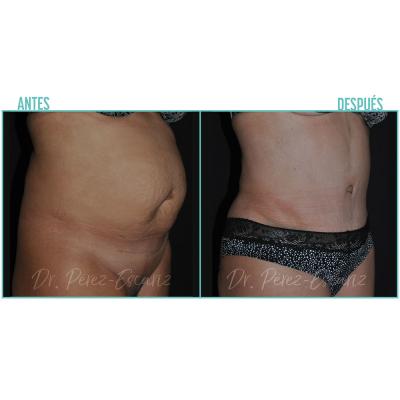 Escariz 211102 Casoreal Abdominoplastia Web2022 7