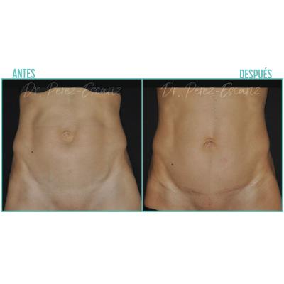 Escariz 201221 Casoreal Abdominoplastia Web2022 3