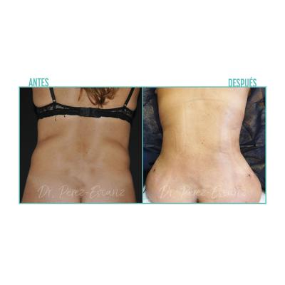 Escariz 200929 Con Casoreal Abdominoplastia Web2022 1