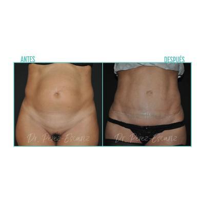 Escariz 200929 Con Casoreal Abdominoplastia Web2022 2