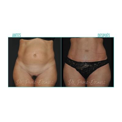 Escariz 200929 Con Casoreal Abdominoplastia Web2022 3