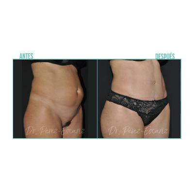 Escariz 200929 Con Casoreal Abdominoplastia Web2022 4