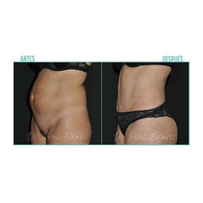 Escariz 200929 Con Casoreal Abdominoplastia Web2022 5