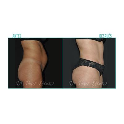 Escariz 200929 Con Casoreal Abdominoplastia Web2022 6