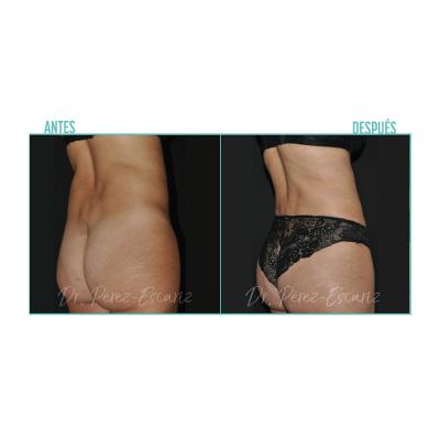 Escariz 200929 Con Casoreal Abdominoplastia Web2022 7