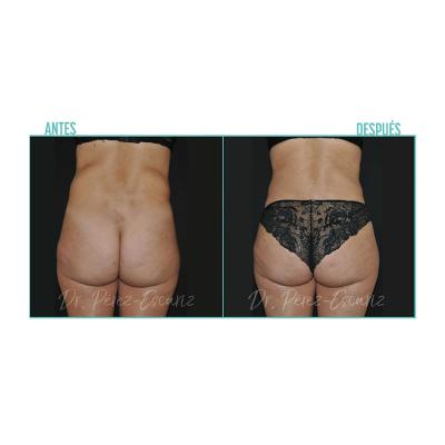 Escariz 200929 Con Casoreal Abdominoplastia Web2022 8