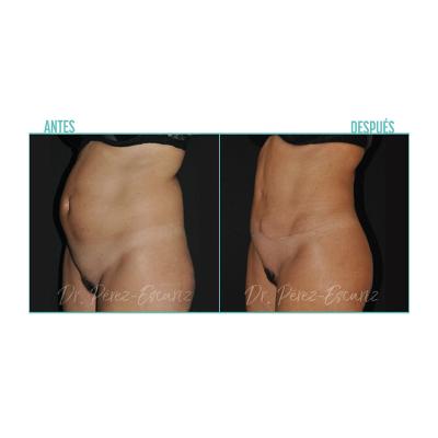 Escariz 200929 Sin Casoreal Abdominoplastia Web2022 2