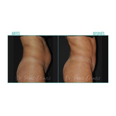 Escariz 200929 Sin Casoreal Abdominoplastia Web2022 3