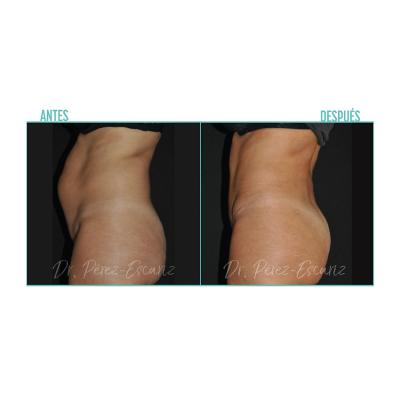 Escariz 200929 Sin Casoreal Abdominoplastia Web2022 4