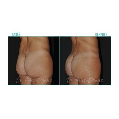 Escariz 200929 Sin Casoreal Abdominoplastia Web2022 5