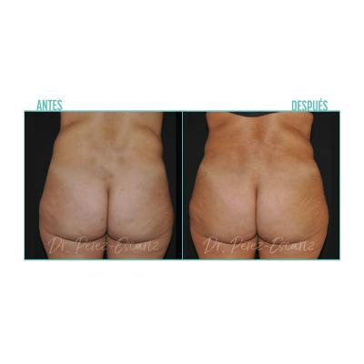 Escariz 200929 Sin Casoreal Abdominoplastia Web2022 6