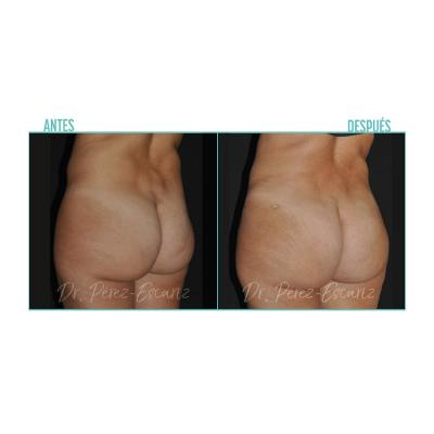 Escariz 200929 Sin Casoreal Abdominoplastia Web2022 7