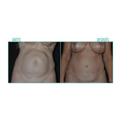 Escariz 200723 Casoreal Abdominoplastia Web2022 1