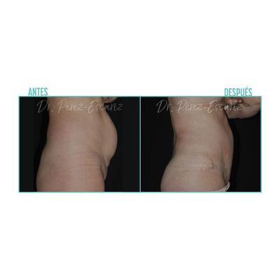 Escariz 200723 Casoreal Abdominoplastia Web2022 2