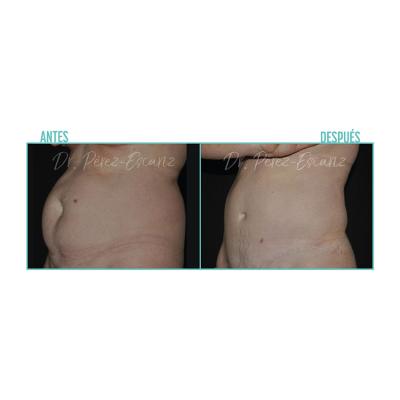 Escariz 200723 Casoreal Abdominoplastia Web2022 4