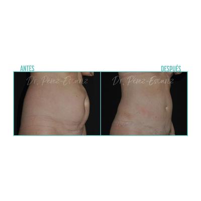 Escariz 200723 Casoreal Abdominoplastia Web2022 5