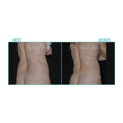 Escariz 200723 Casoreal Abdominoplastia Web2022 6