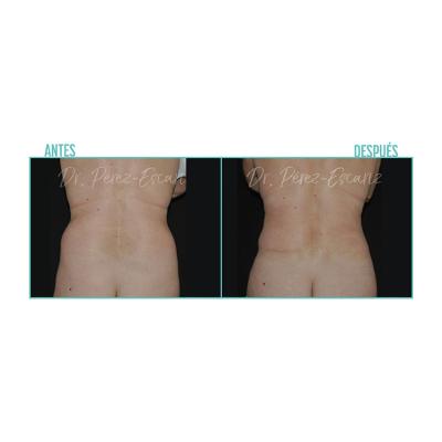 Escariz 200723 Casoreal Abdominoplastia Web2022 7