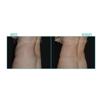 Escariz 200723 Casoreal Abdominoplastia Web2022 8